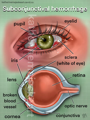 Subconjunctival hemorrhage