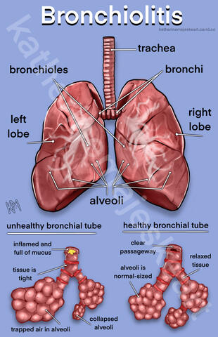 Bronchiolitis