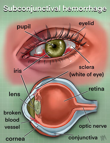 Subconjunctival Hemorrhage
