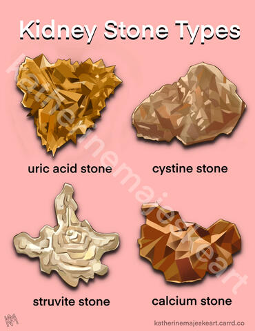 Kidney stones