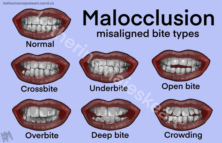 Malocclusion